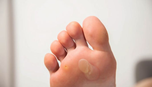 Protege tus pies del rozamiento con nuestros productos anti rozaduras pies